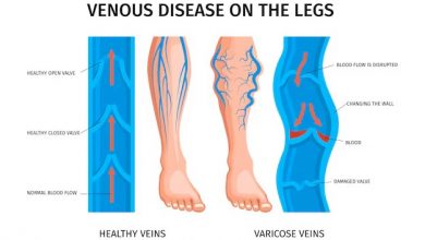 understanding-varicose-veins:-causes,-symptoms,-and-treatments