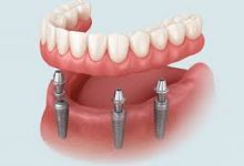 dental-implants-in-the-dominican-republic-and-cost:-affordable-‎smiles-abroad